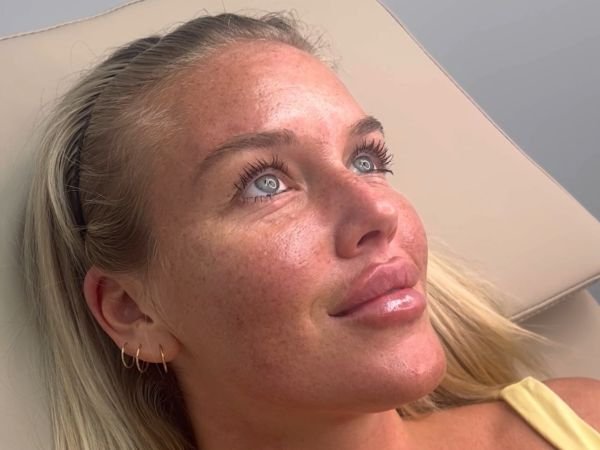 Wrinkle Reduction Treatments