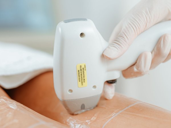 Laser Hair Removal