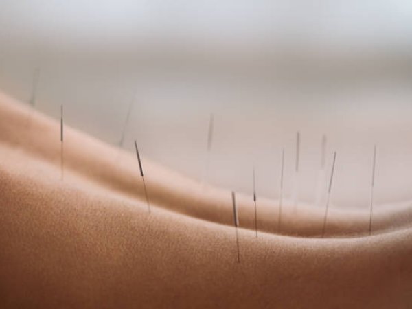 Acupuncture